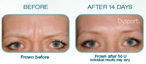 dysport-before-after-1