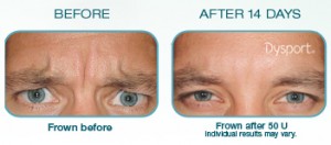 dysport-before-after-2